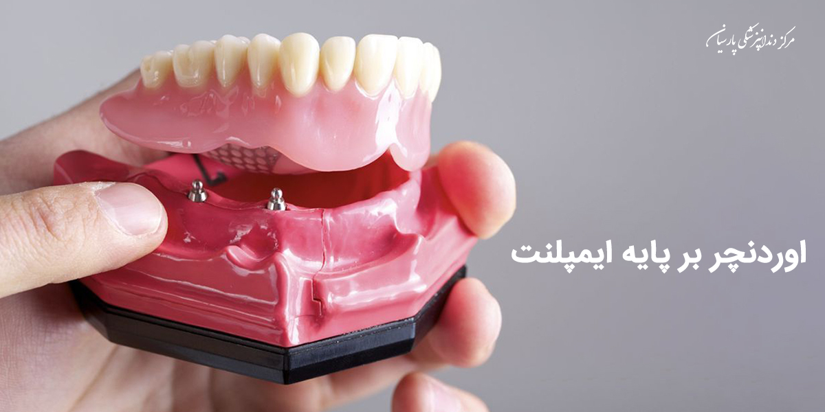 اوردنچر بر پایه ایمپلنت یعنی چه ؟