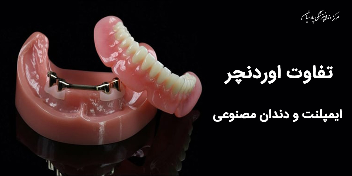 تفاوت اوردنچر با ایمپلنت و دندان مصنوعی چیست ؟