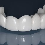 لمینت متحرک دندان برای چه کسانی مناسب است؟