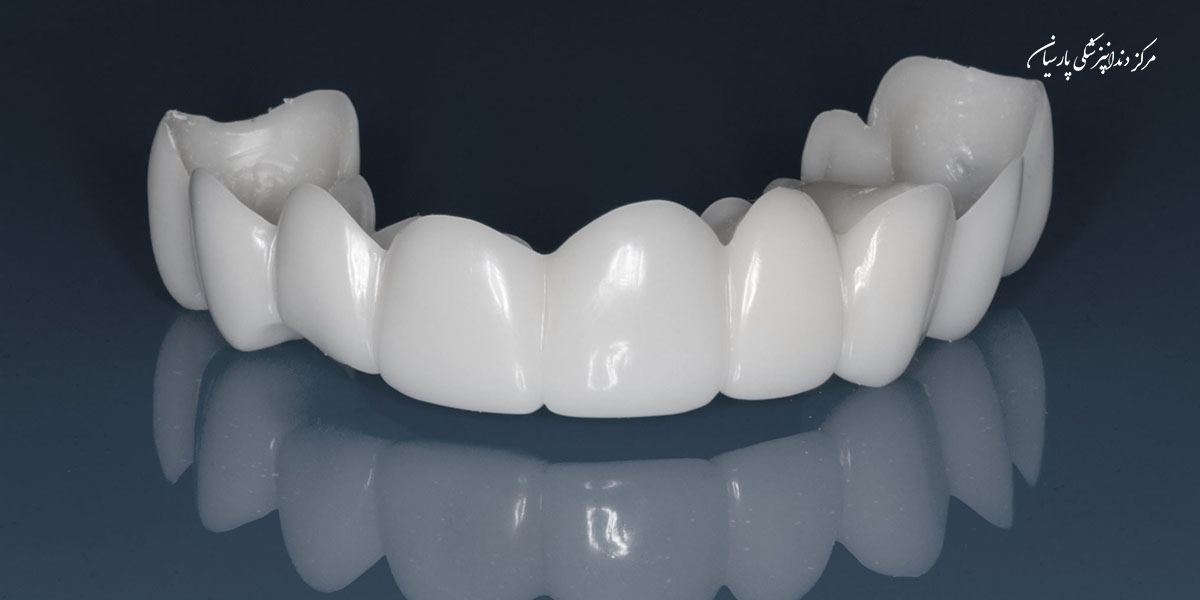 لمینت متحرک دندان برای چه کسانی مناسب است؟