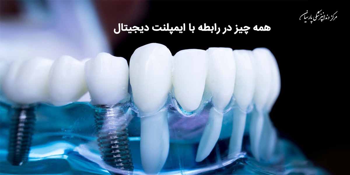 همه چیز در رابطه با ایمپلنت دیجیتال که باید بدانید