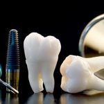 پس زدن ایمپلنت چه زمانی اتفاق می افتد ؟