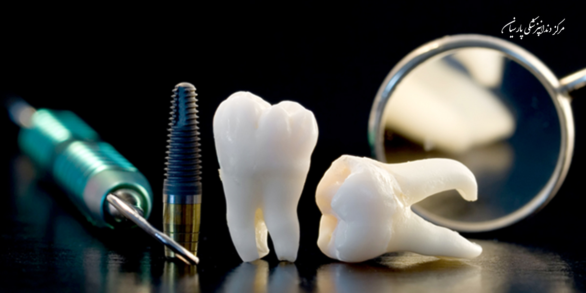 پس زدن ایمپلنت چه زمانی اتفاق می افتد ؟