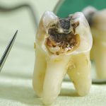 از نکروز دندان چه اطلاعاتی دارید ؟