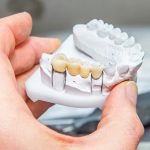 مزایا و معایب استفاده از بریج دندان چیست ؟