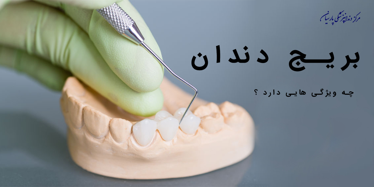 کاربرد و ویژگی های مهم بریج دندان چیست ؟