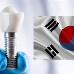 بایدهای و نبایدهایی از ایمپلنت کره ای که شما نمیدانید