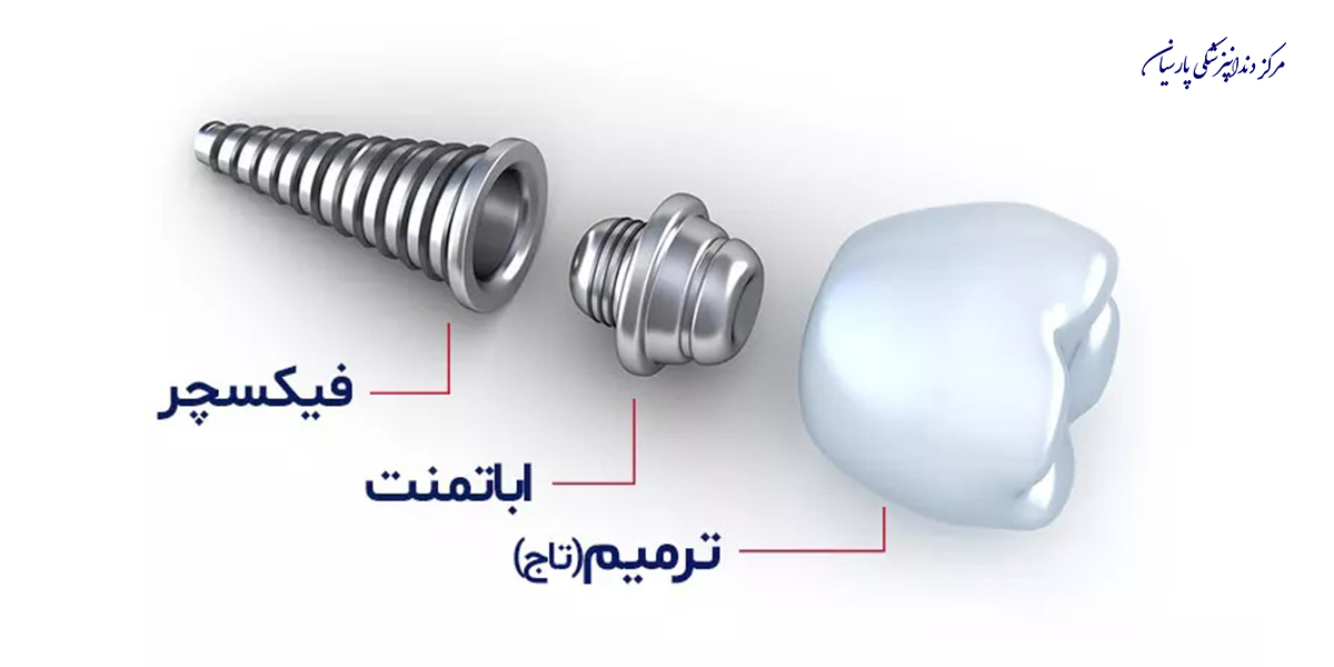 فیکسچر ایمپلنت چه کاربردی دارد ؟
