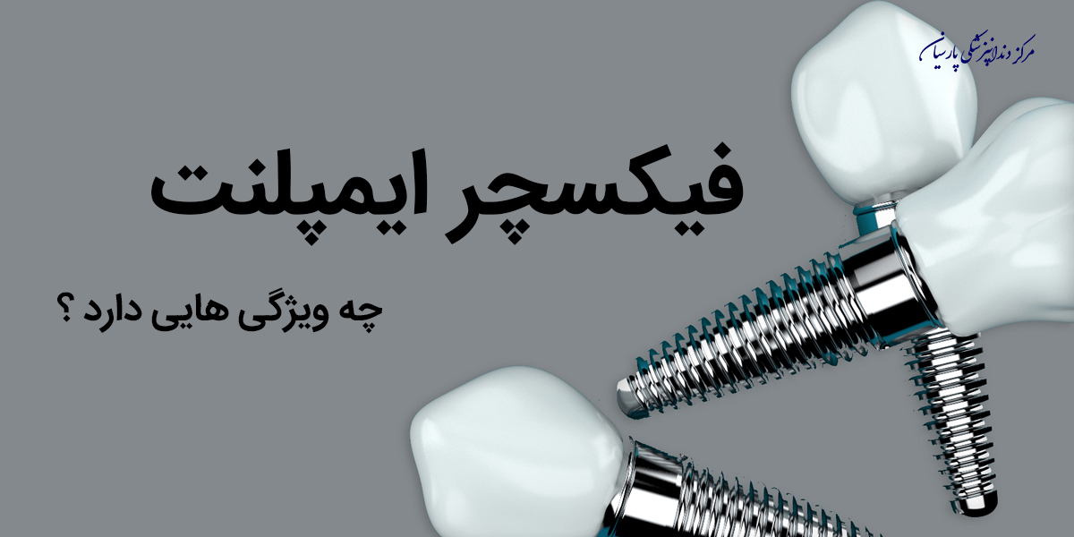 همه چیز در رابطه با فیکسچر ایمپلنت که باید بدانید