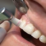 همه چیز در رابطه با پولیش دندان که باید بدانید