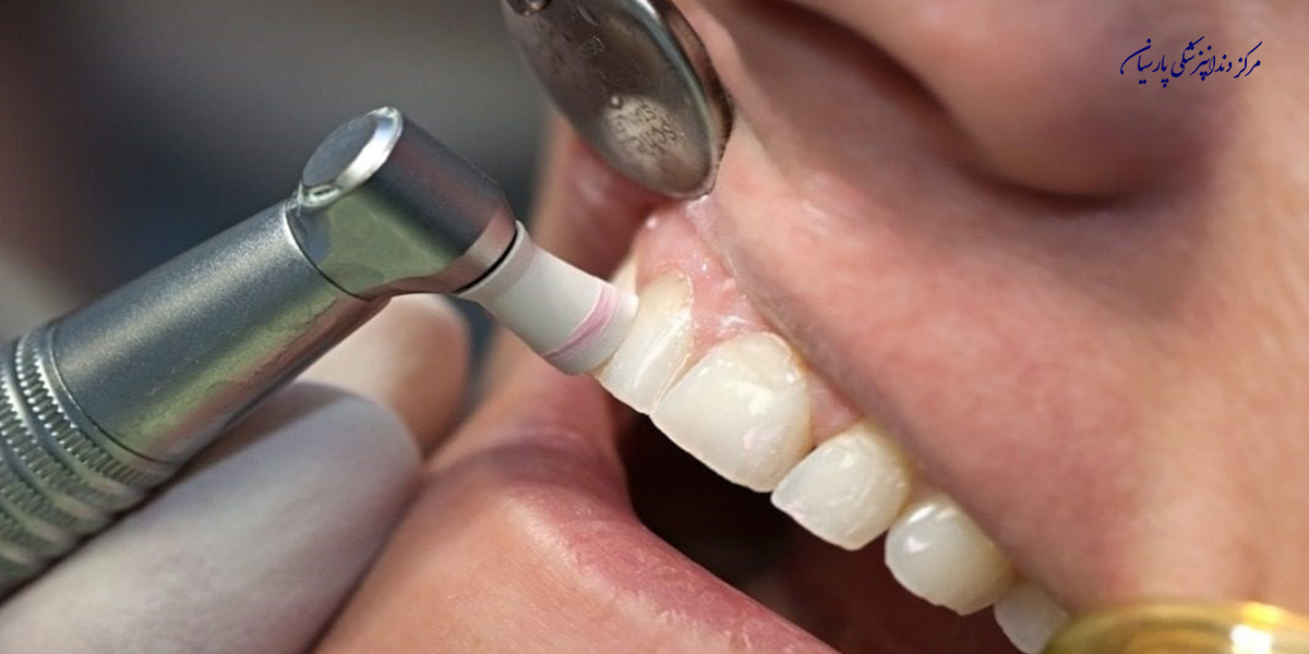 همه چیز در رابطه با پولیش دندان که باید بدانید