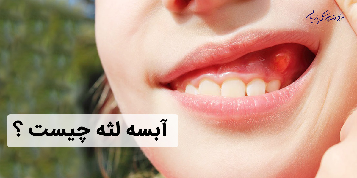 آبسه لثه چیست و چه درمانی دارد ؟