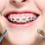 روشهای درمان پوسیدگی دندان حین ارتودنسی که باید بدانید