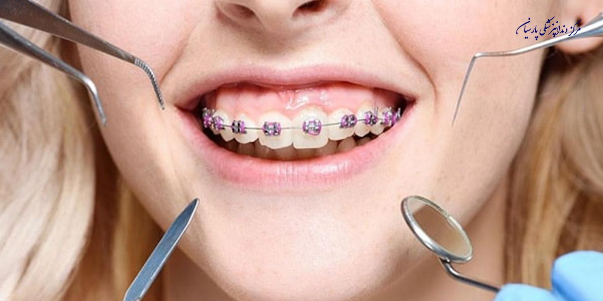 روشهای درمان پوسیدگی دندان حین ارتودنسی که باید بدانید