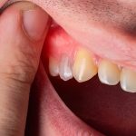 همه چیز در رابطه با آبسه لثه که لازم است بدانید