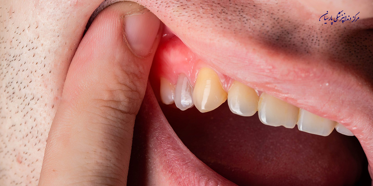 همه چیز در رابطه با آبسه لثه که لازم است بدانید