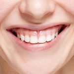 همه چیز در رابطه با جراحی لیفت لثه که لازم است بدانید