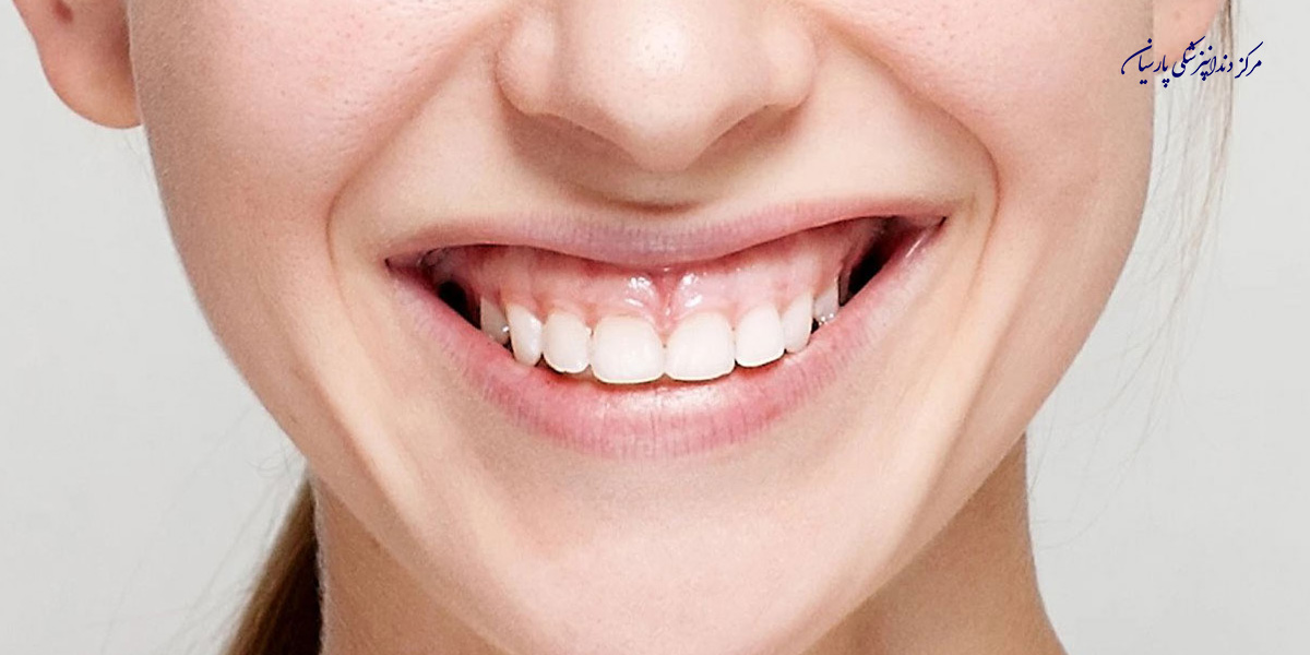 همه چیز در رابطه با جراحی لیفت لثه که لازم است بدانید