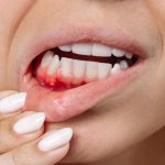 همه چیز در رابطه با خونریزی لثه در بارداری که لازم است بدانید