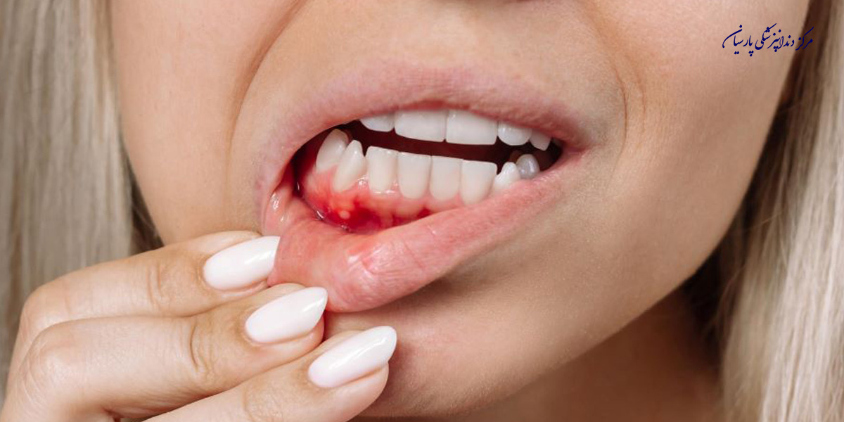 همه چیز در رابطه با خونریزی لثه در بارداری که لازم است بدانید