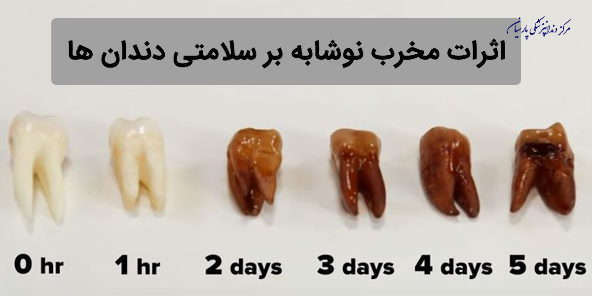 اثرات مخرب نوشابه بر سلامتی دندان ها