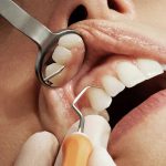 بایدها و نبایدهایی از جرمگیری لثه که لازم است بدانید