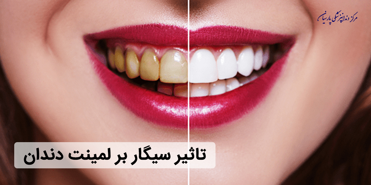تاثیر سیگار بر لمینت دندان و مشکلاتی که به همراه دارد ؟