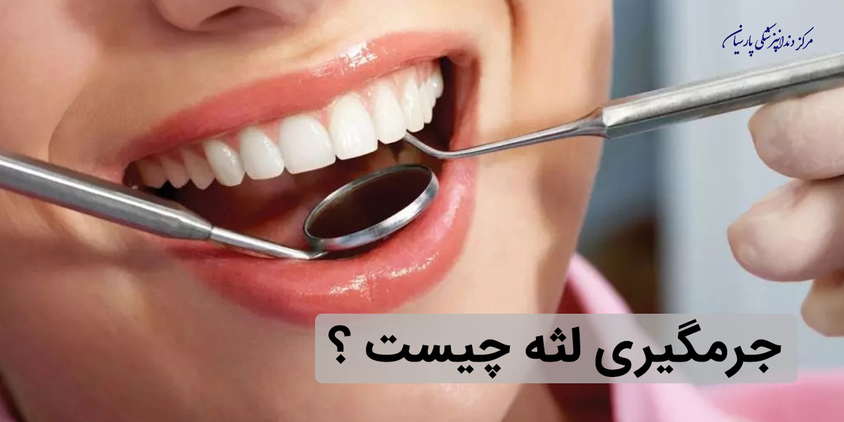 جرمگیری لثه چه تاثیری در سلامت دهان و دندان ها دارد ؟