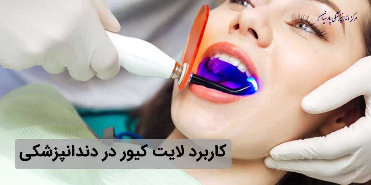 علت استفاده از دستگاه لایت کیور در دندانپزشکی