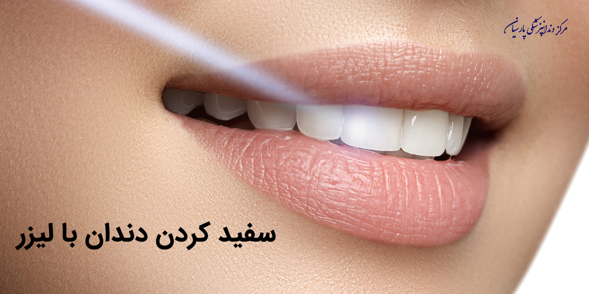 منظور از سفید کردن دندان با لیزر چیست و چگونه انجام میشود ؟