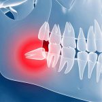 اگر دندانپزشک توصیه کرده دندان عقل نهفته خود را بکشید، نگران نباشید زیرا این دندانها تاثیری در زیبایی و راحتتر جویدن غذا ندارد. بنابراین بهتر است برای جلوگیری از عفونت و آسیب به دندانهای مجاور در اسرع وقت برای کشیدن آن اقدام کنید. دندانپزشک عمومی میتواند دندانعقل نهفته را جراحی کند اما در صورتی که این دندان در فک پایین به سمت عصب یا در فک بالا به سمت سینوس رشد کرده باشد، باید توسط متخصص جراحی شود.
