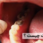 همه چیز در رابطه با درای ساکت یا حفره خشک دهان که باید بدانید