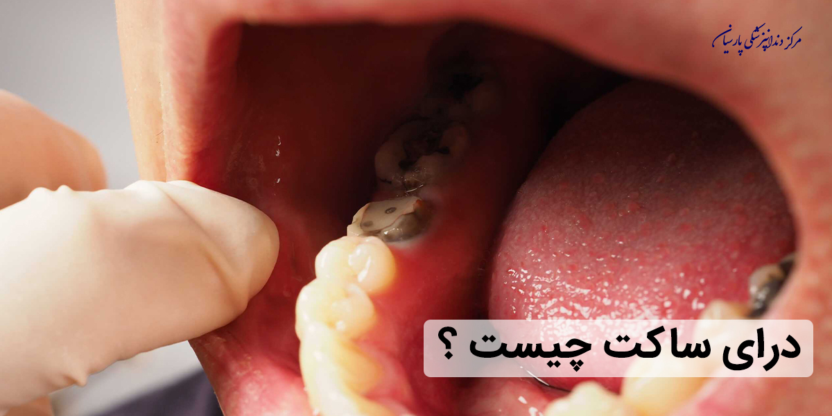 همه چیز در رابطه با درای ساکت یا حفره خشک دهان که باید بدانید