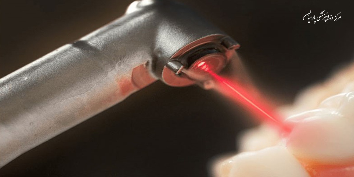همه چیز در رابطه با سفید کردن دندان با لیزر که لازم است بدانید