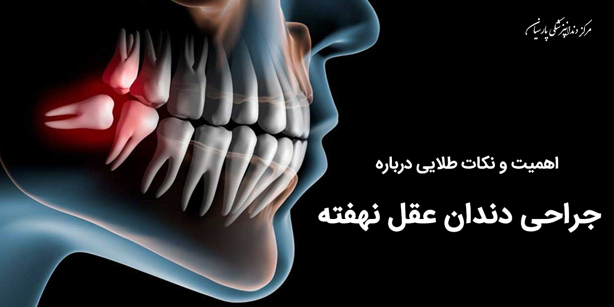 چرا جراحی دندان عقل نهفته مهم است ؟