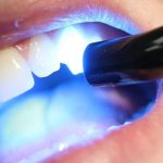 کاربرد لایت کیور در دندانپزشکی گه لازم است بدانید