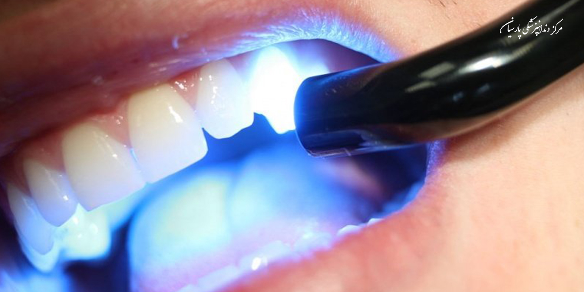 کاربرد لایت کیور در دندانپزشکی گه لازم است بدانید