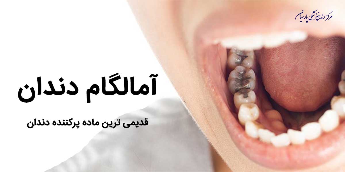 آمالگام دندان قدیمی ترین ماده پركننده دندان