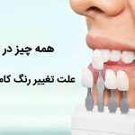 باید ها و نبایدهای علت تغییر رنگ کامپوزیت دندان که لازم است بدانید