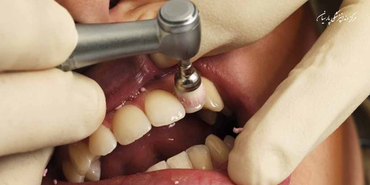 همه چیز در رابطه با پالیش کامپوزیت دندان که لازم است بدانید
