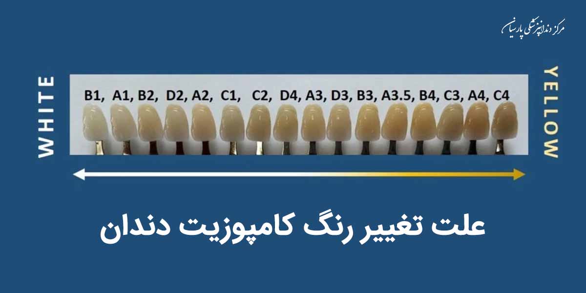 همه چیز در رابطه تغییر رنگ کامپوزیت دندان که لازم است بدانید