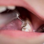 همه چیز درباره آمالگام دندان که باید بدانید