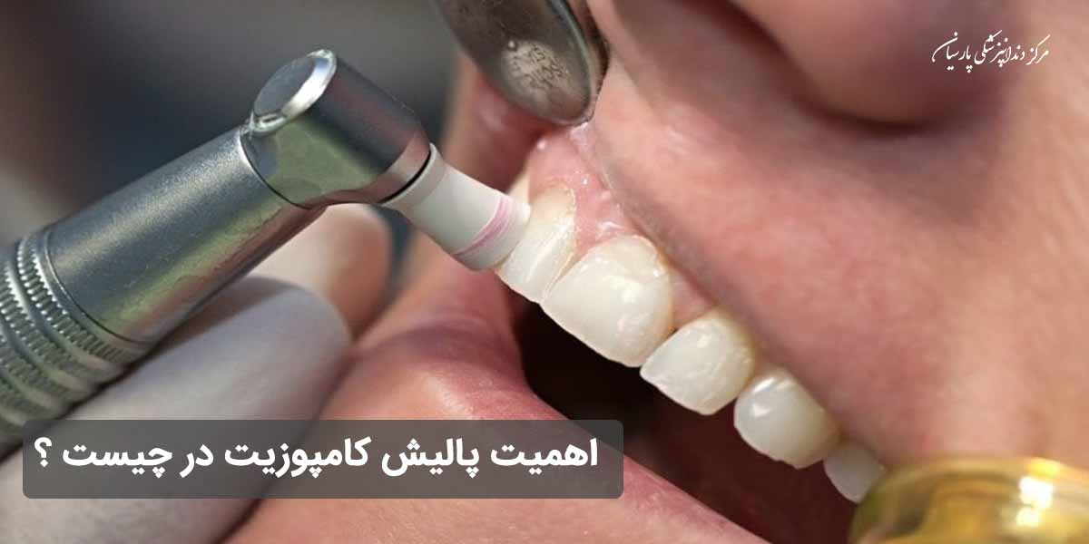 پالیش کامپوزیت دندان چه ضرورتی دارد ؟