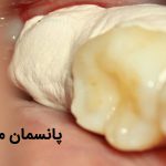 پانسمان موقت دندان و نکات طلایی در مراقبت از آن