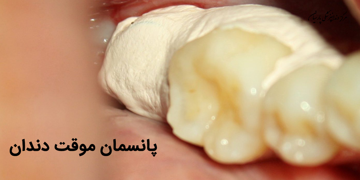 پانسمان موقت دندان و نکات طلایی در مراقبت از آن