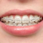 بایدها و نبایدهایی از ارتودنسی سرامیکی که لازم است از آن مطلع باشید