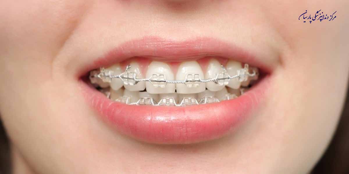 بایدها و نبایدهایی از ارتودنسی سرامیکی که لازم است از آن مطلع باشید
