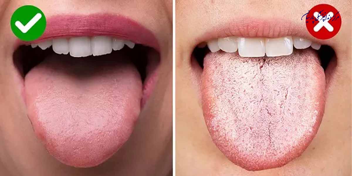 بایدها و نبایدهایی از علت سفیدی زبان که از آن آگاهی ندارید