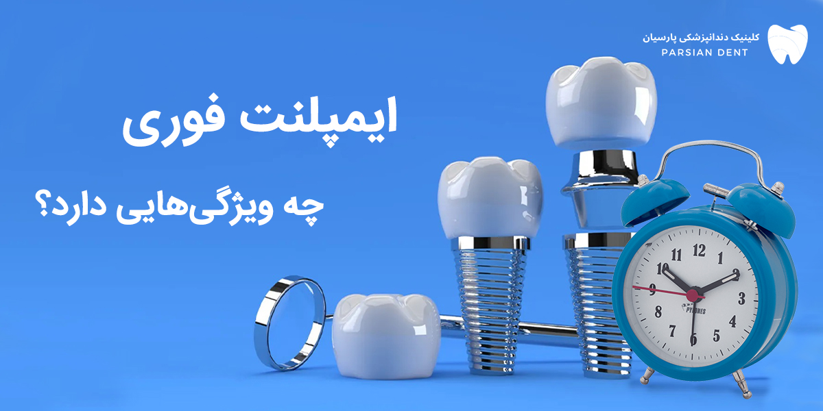 ایمپلنت فوری چه ویژگی هایی دارد ؟