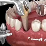 بایدها و نبایدهایی از ایمپلنت فوری که لازم است بدانید